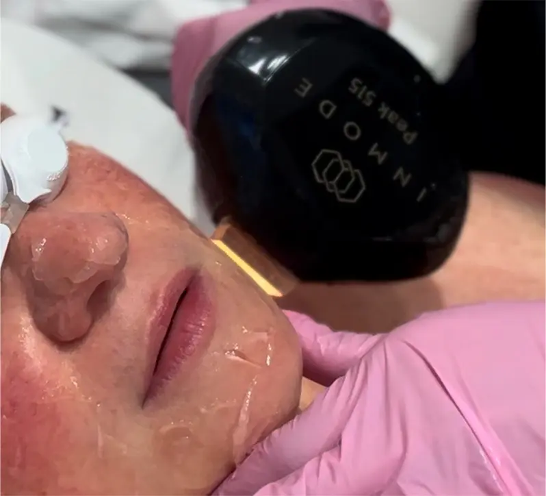 Lumecca IPL In Orlando by Vivify Aesthetics LLC